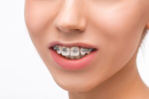 Clear Aligners