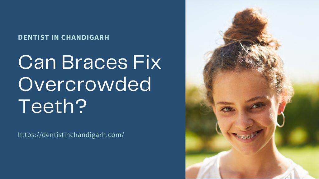 Can Braces Fix Overcrowded Teeth? 1 Braces