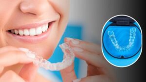 clear aligners in Chandigarh