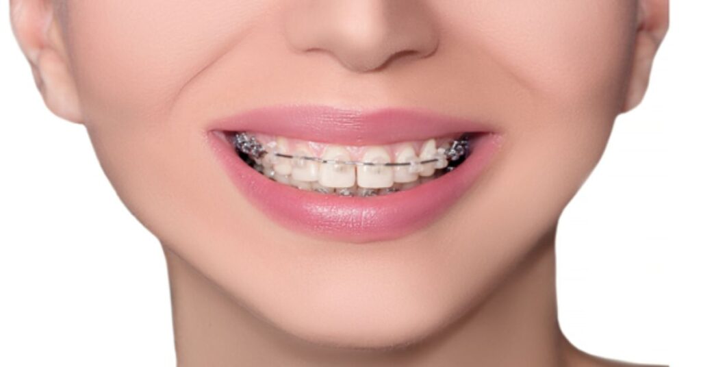 How Do Braces Actually Move Teeth Over Time? 1 braces