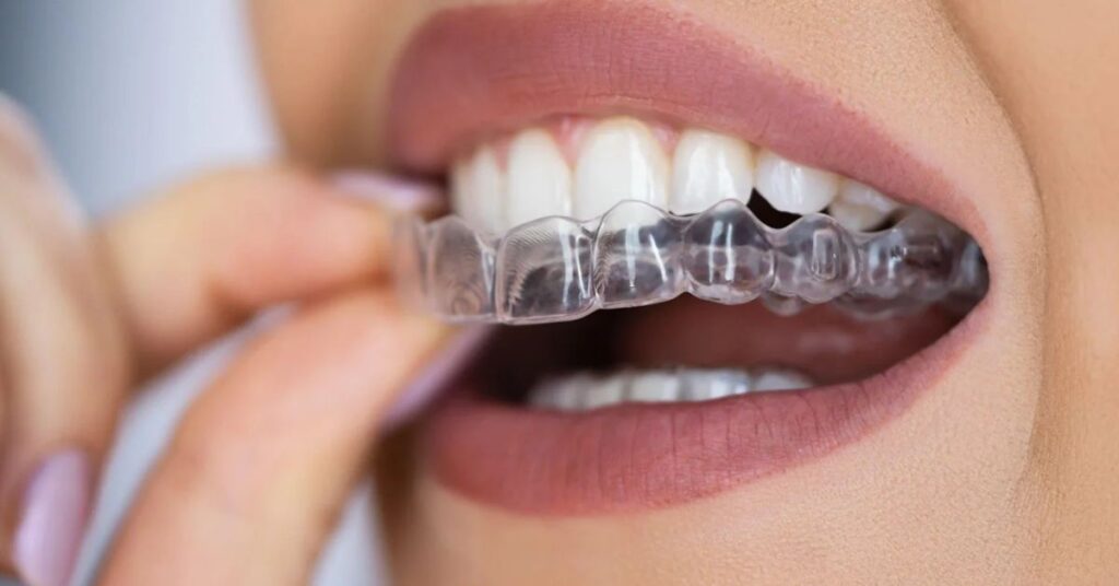 What Daily Habits Help Clear Aligners Work Effectively? 1 clear aligners in Chandigarh