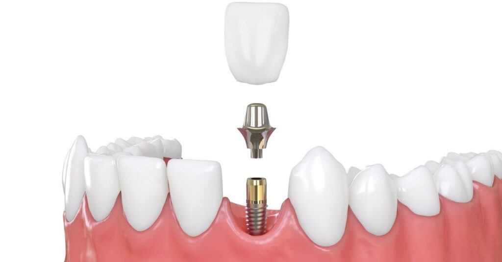How Do Dentists Plan Accurate Dental Implant Placement? 1 Dental Implants 1