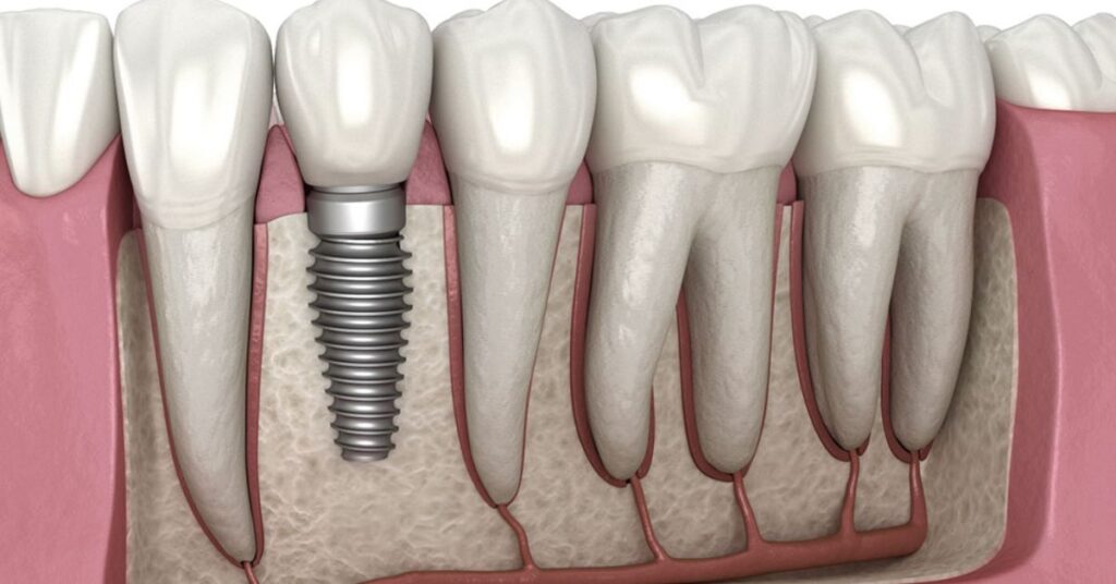 What Makes Dental Implants Feel Like Natural Teeth? 1 Dental Implants