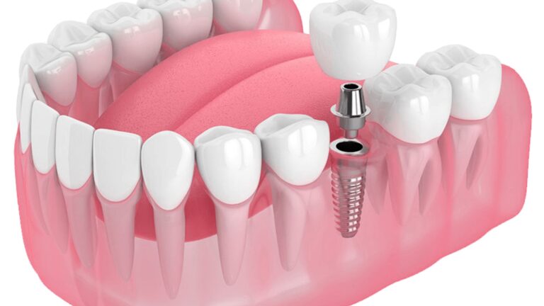 How Do Dentists Plan Accurate Dental Implant Placement
